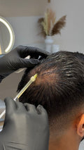 PRP Mesotherapy (Hair restoration)