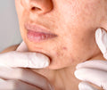 Treatments offered by Department of Dermatology
